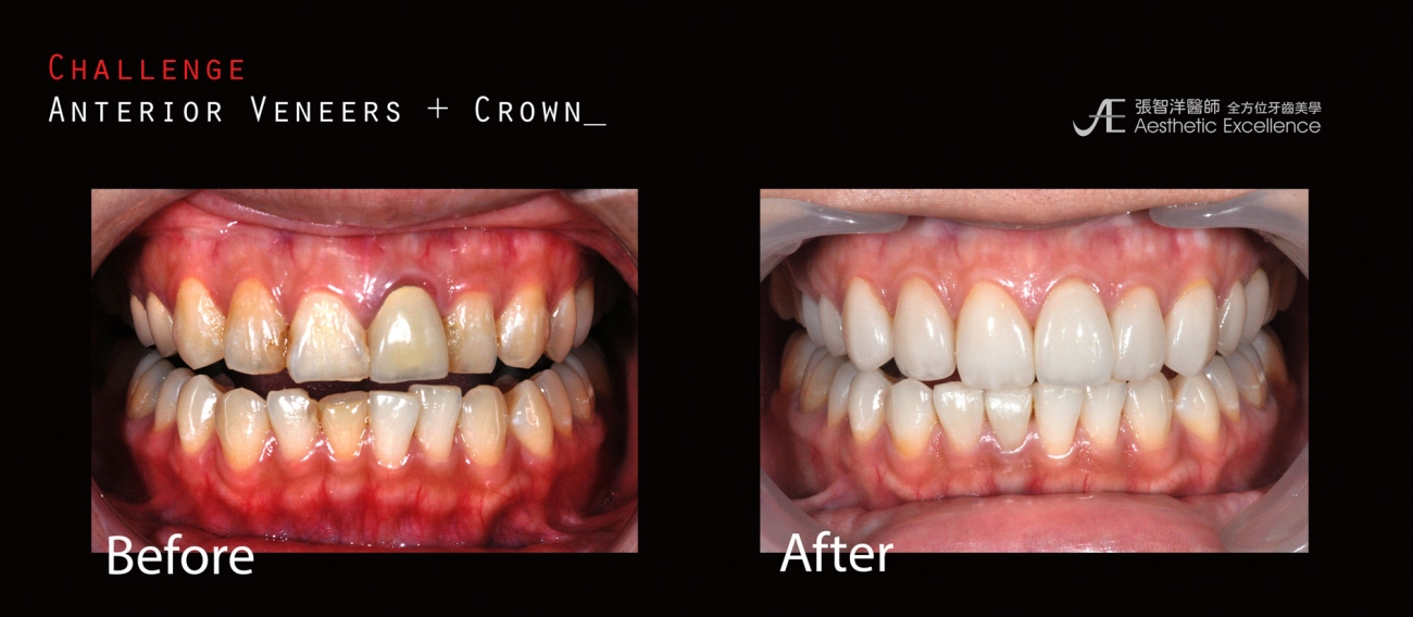景正牙醫-全瓷貼片＋全瓷牙冠-藝人門面大改造.jpg