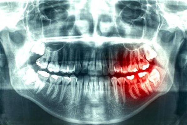 Neuro-Muscular-Dental-xray-牙齒莫名的疼痛_1_顳顎關節偏移症候群_景正牙醫_張智洋醫師small
