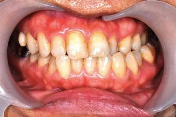 顳顎關節偏移-治療前1-顳顎關節症候群Neuromuscular-Disorder-張智洋醫師small-350x233