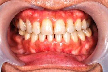 顳顎關節偏移-治療後1-顳顎關節症候群Neuromuscular-Disorder-張智洋醫師small-350x233