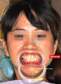 顳顎關節偏移-治療前2-顳顎關節症候群Neuromuscular-Disorder-張智洋醫師small-1-253x350