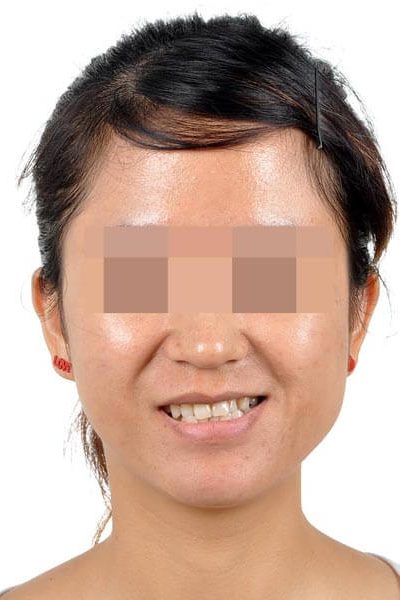 -治療前3-顳顎關節症候群Neuromuscular-Disorder-張智洋醫師small-q6b96a2rd7pfyv0z0xbcau5g6ccqz5m9qy0fs3ta40