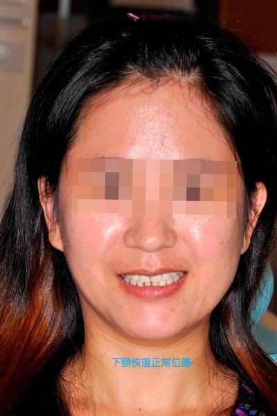 -治療後3-全方位牙齒美學權威-張智洋醫師small-q6b99q5gfcfaje0qwey3fyual7d777au804j4mpbao