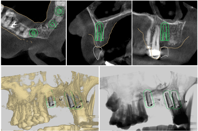 3D列印與CADCAM如何改變了牙科治療5
