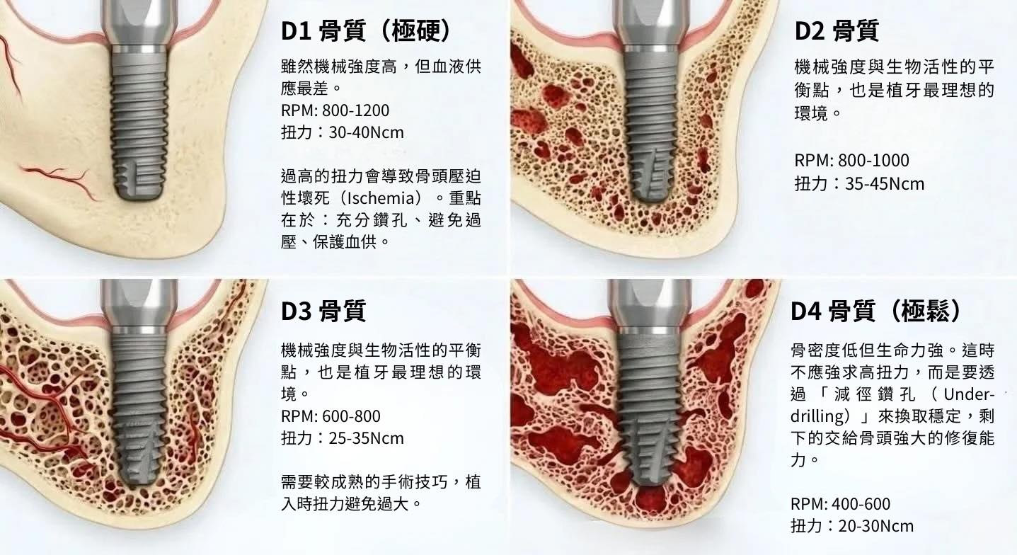 為什麼植牙不是「鎖越緊越好」?聽聽專業醫師怎麼說
